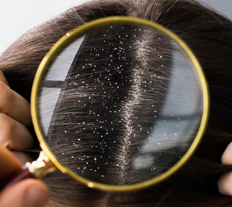 Hair Fall Treatment
